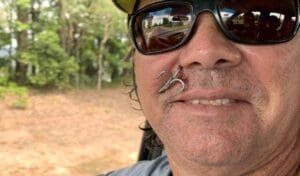 fish hook accident in face