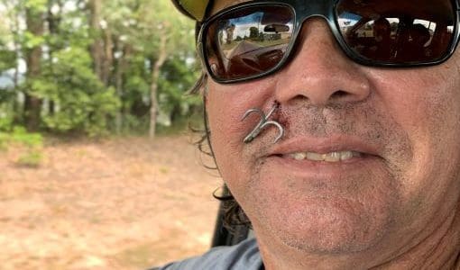 fish hook accident in face