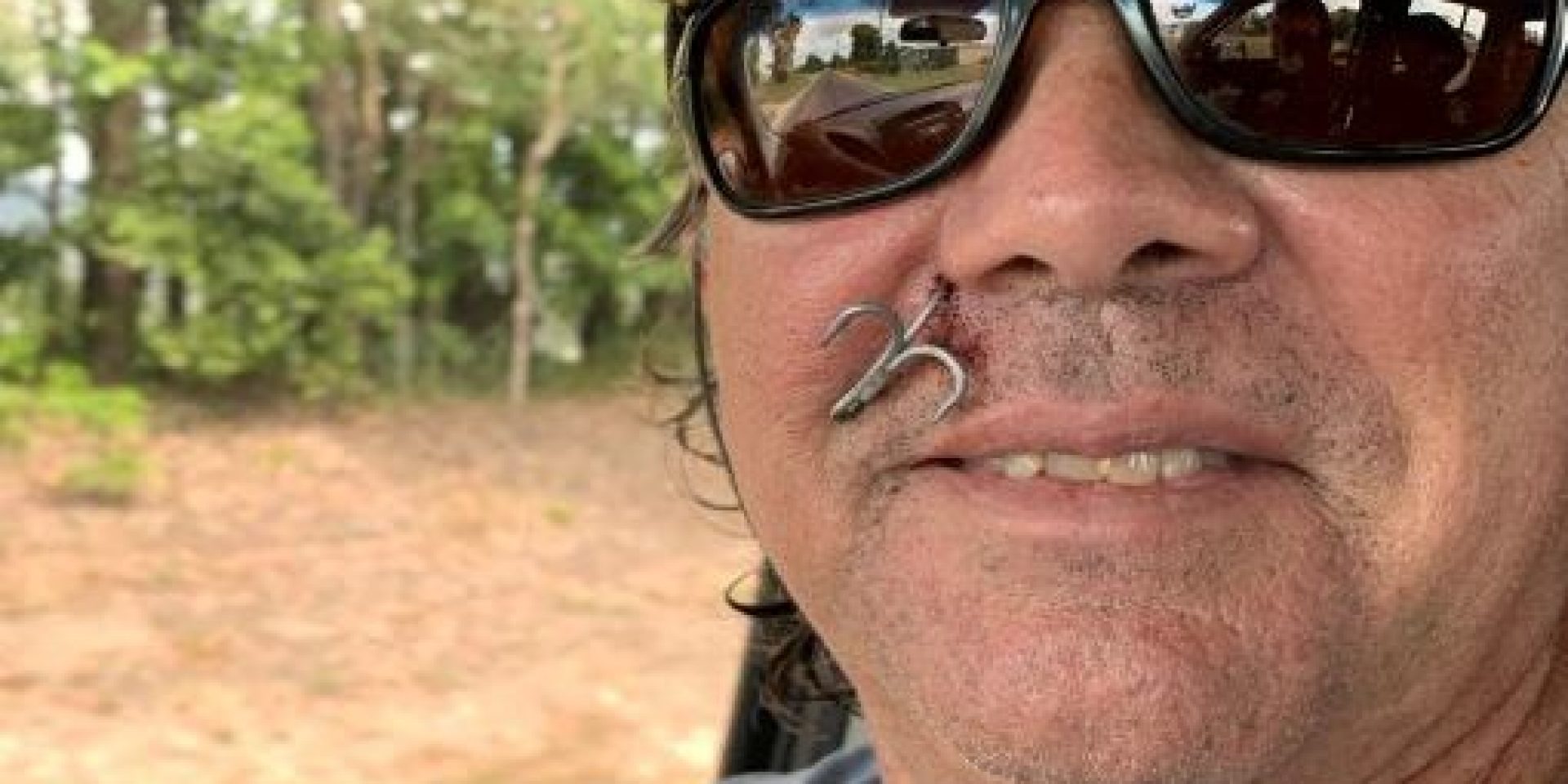 fish hook accident in face